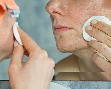 بهترین تکنیک برای شستشوی پوست جوش دار